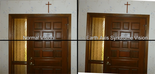 Earth Axis Syndrome – Tilted Vision